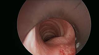 Subglottic PostIntubation Tracheal Injury [upl. by Aynekat]