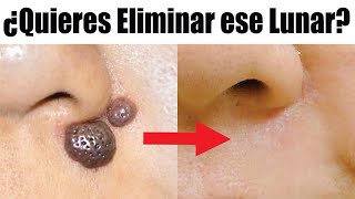 Cómo ELIMINAR LUNARES 💋 VERRUGAS SIRINGOMAS y ACROCORDONES 😊 ETERNA JUVENTUD ESTETIC CENTER [upl. by Lebasiram471]