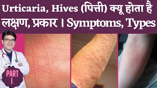 Skin Rash Urticaria Hives Causes Types Symptoms I Urticaria Hives Kyu Hota hai lakshan kya hai [upl. by Coretta]