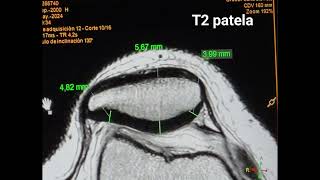 CASO RESONANCIA MAGNETICA DE RODILLA ‐ Hecho con Clipchamp [upl. by Berman16]