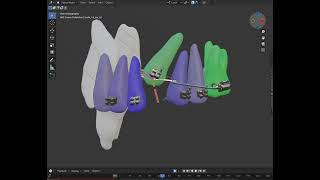 Treat an impacted canine with minimum side effect on adjacent teeth using simulation software [upl. by Auqinehs]