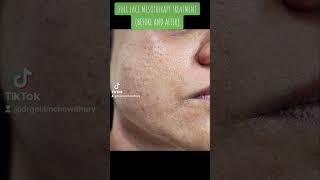 Full Face Mesotherapy TREATMENT BEFORE AND AFTER [upl. by Belden]