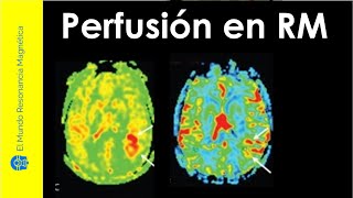 Vídeo 21 PERFUSIÓN CEREBRAL por Resonancia Magnética Secuencias T2 T1 y ASL CON o SIN Contraste [upl. by Antin681]