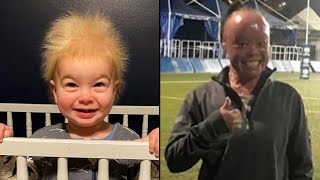 Uncombable Hair Syndrome and Other Rare Genetic Conditions [upl. by Charters]