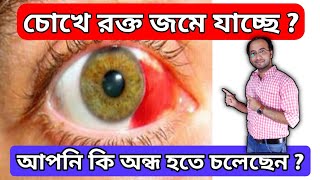 চোখের সাদা অংশে রক্ত ​​জমাট বাঁধা  subconjunctival hemorrhage in Bengali  optometrist eye health [upl. by O'Conner614]