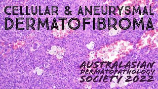 Cellular Dermatofibroma amp Aneurysmal Dermatofibroma 101 pathology dermpath dermatology [upl. by Rap619]