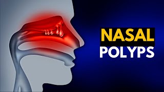 NASAL POLYPS Causes SIgns and Symptoms Diagnosis and Treatment [upl. by Saito]