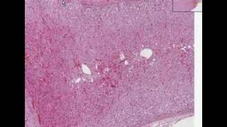 Histopathology AdrenalCortical adenoma [upl. by Noinatrad401]