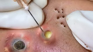 big blackheads removal  pimple popping  Dr Derm [upl. by Mirth28]