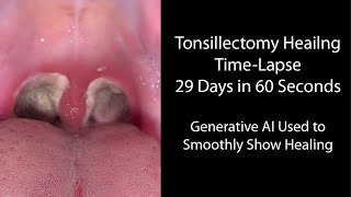 Healing Time Lapse After Tonsillectomy 029 Days in 60 Seconds [upl. by Enilrek277]