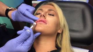 Microdroplet lip injection Using Restylane Juvederm [upl. by Winnie]