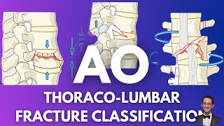 AO Classification Thoracolumbar Fractures [upl. by Noicnecsa]