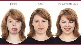 Makeup to Hide Port Wine Stains amp Birthmarks  jane iredale [upl. by Emiolhs]