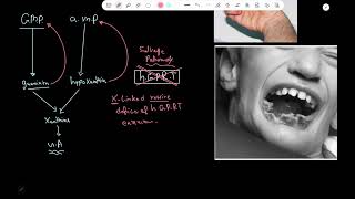 LeschNyhan syndrome  Pathology [upl. by Echo597]