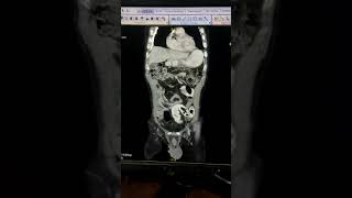 GASTROENTEROLOGY  Identify the spot diagnosis in given CECT ABDOMEN clip [upl. by Irej]