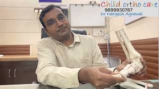 Metatarsal Adductus can be corrected childorthocare clubfoot ctev clubfeet टेसेमेडेपैर [upl. by Ahseenak]