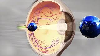 Lente Intraocular opacoCapsulotomía Yag LaserOpacidad de Cápsula Posterior [upl. by Artenehs]