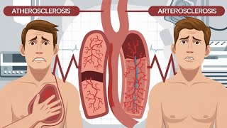 what is CVD  Difference between Atherosclerosis and arteriosclerosis  Usamaghazlani804 [upl. by Lucretia]