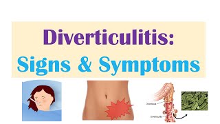 Diverticulitis Signs amp Symptoms And Why They Occur [upl. by Eemiaj]