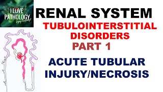 ACUTE TUBULAR INJURYNECROSIS or ACUTE KIDNEY INJURY  Pathology [upl. by Anifled]