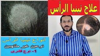 تينيا فروة الرأس القراع🤔 تعرف على أسبابها وأعراضها والوقاية منها 😣📝 وروشتة علاج📋 👍👌💇 [upl. by Guerra56]