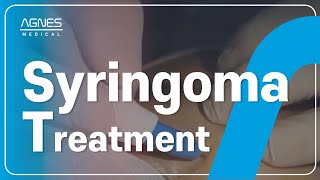 AGNES  Treatment AGNES The Gold Standard for Syringoma Treatment 👍 AGNES AGNESRF Syringomas [upl. by Nae780]