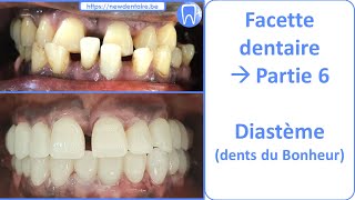 Facette dentaire et dents du bonheur Diasteme  Guide complet  partie 6 [upl. by Oiramal]