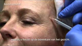 BeautyJournaal TV Actrice Inge Ipenburg krijgt Sculptra injectables [upl. by Alehtse]