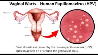 WARTS HPV [upl. by Brander12]