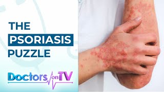 Psoriasis Know the Symptoms Causes and available Treatments from Dermatology Specialist [upl. by Stacia935]