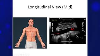 Using POCUS to screen for Abdominal Aortic Aneurysm AAA [upl. by Itsyrc715]