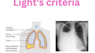 Pleura  Pleural effusion  Lights criteria  Transudate  Exudate Empyema [upl. by Ethan]