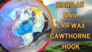 Hard as nails earwax vs cawthorne hook with ear wax removal [upl. by Aikar730]