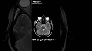 radiology التشخيصالطبي radiologylife masticator temporalis hemangioma venous malformation [upl. by Jacy]