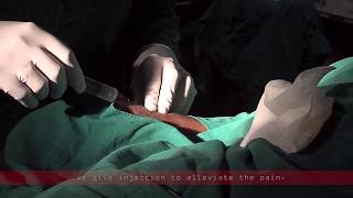 Coronary angiogram  a live demonstration [upl. by Ahsha]