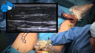 Endovenous Laser Ablation EVLA of Great Saphenous Vein  varicose veins [upl. by Valentijn]