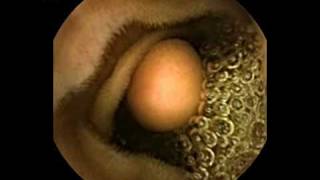 Capsule endoscopy small bowel polypmpg [upl. by Juan]