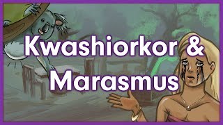 Kwashiorkor vs Marasmus  Nutrition Mnemonic [upl. by Seadon101]