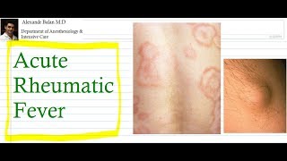 Acute Rheumatic Fever [upl. by Redwine174]