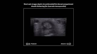 De Quervain tenosynovitis on dynamic wrist ultrasound [upl. by Yur]