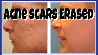 HOW TO COVER ACNE SCARS FLAWLESSLY  Tutorial  CHRIS GIBSON [upl. by Scheld]