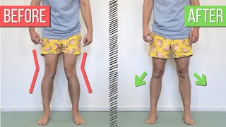 How to Fix Knock Knees Valgus Knees [upl. by Nutsud820]