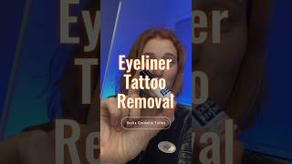 Saline eyeliner tattoo removal [upl. by Reiners]