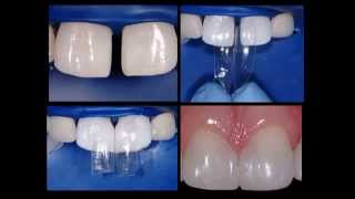 Bioclear  Diastema Closure [upl. by Aysan]