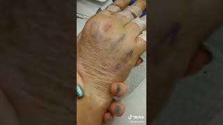 Hand reconstructive surgery removing stitches video 3 [upl. by Moitoso167]