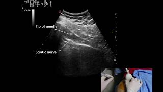 Ultrasound guided piriformis injection by Murat Karkucak MD [upl. by Maximilianus]