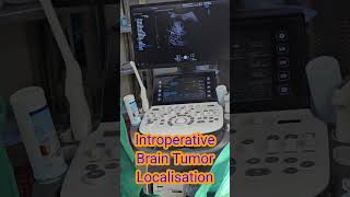 Affordable Brain Tumor Treatment in India  Dr Sandeep Moolchandani Consultant Neurosurgeon [upl. by Dermot]