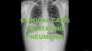 Clinical Case  Cavitating pneumonia  Chest Xray and CT Scan  Radiology tutorial [upl. by Chuch]