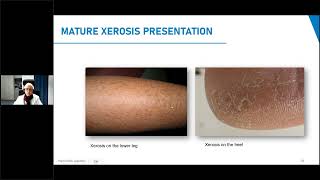 CeraVe SkinChat Mature Xerosis Patients Considerations and Tips for Epidermal Barrier Maintenance [upl. by Reynold602]