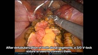 Robotic augmentation cystoplasty with supratrigonal cystectomy [upl. by Millian480]